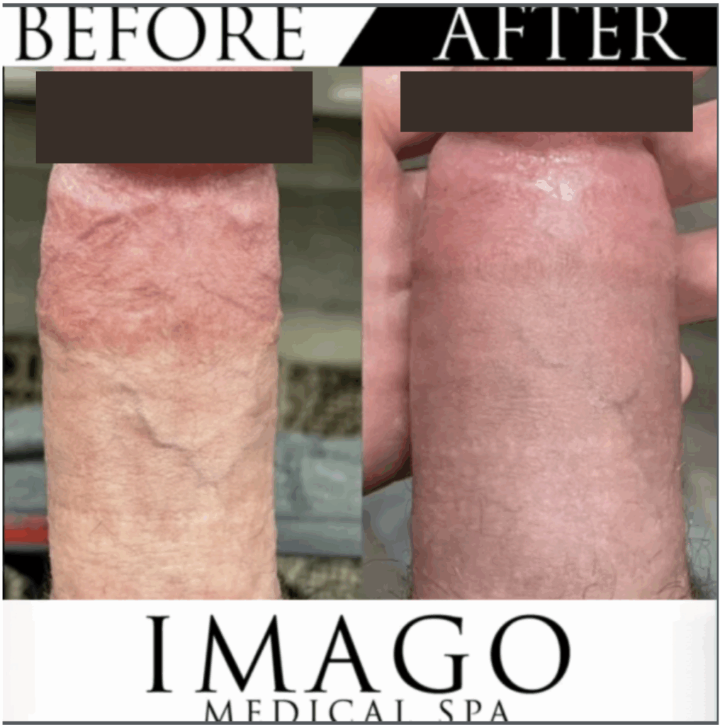 Before and after permanent penis enlargement medical procedure by Imago Medical Spa