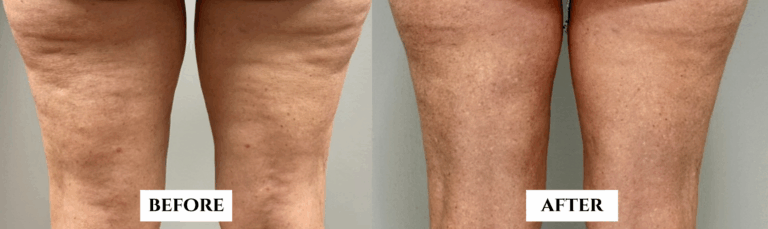 before and after nonsurgical cellulite treatment on legs performed by Imago Medical Spa