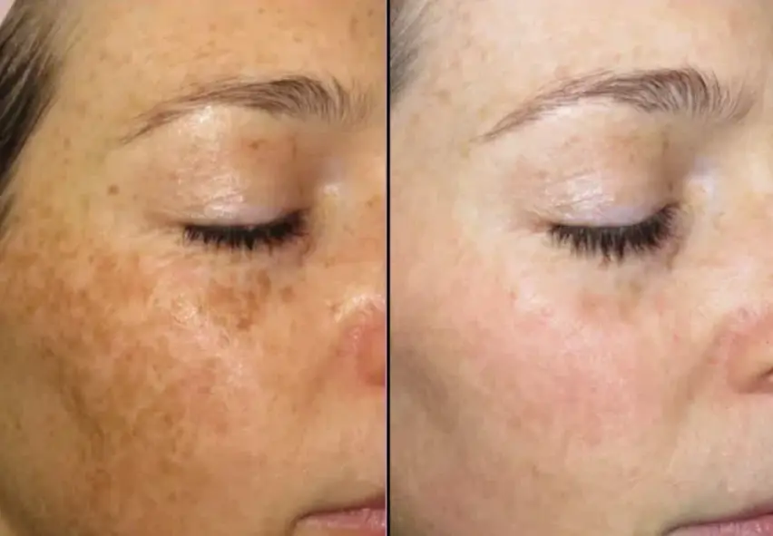 hyperpigmentation Treatment