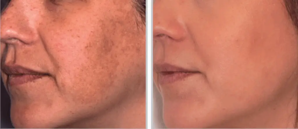 Hyperpigmentation treatment
