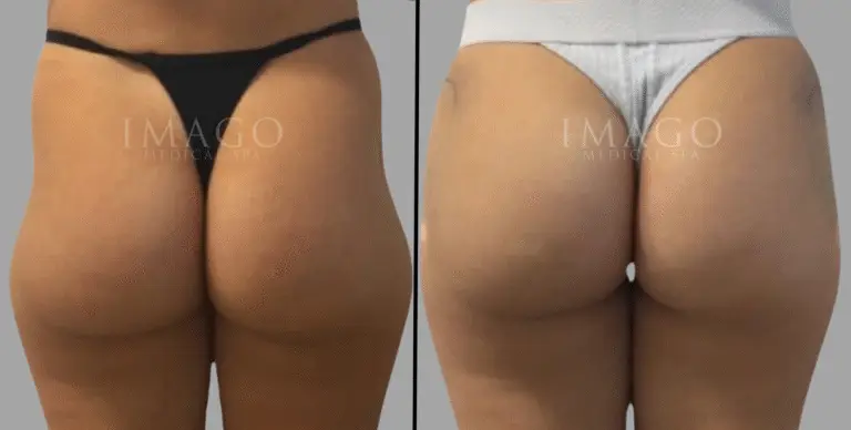 nonsurgical BBL before & after