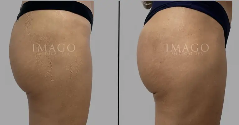 nonsurgical BBL before & after