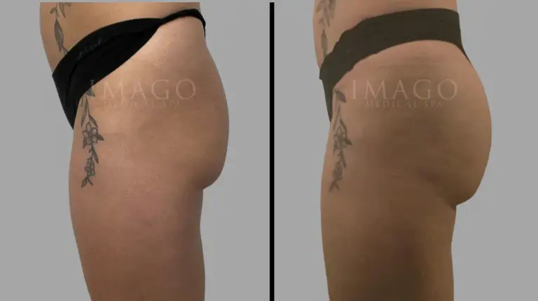 nonsurgical BBL before & after