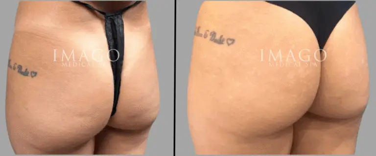 nonsurgical BBL before & after