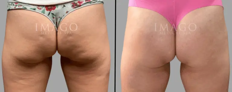 nonsurgical BBL before & after