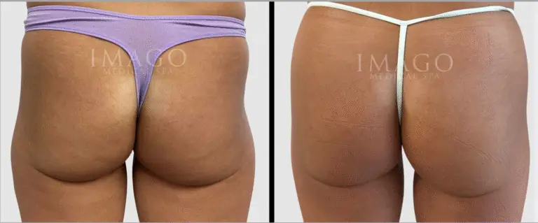 nonsurgical BBL before & after