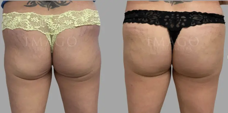 nonsurgical BBL before & after