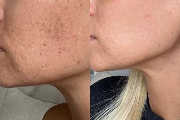 70510457-12023327-This_Laser_Clinics_Australia_Bondi_customer_had_just_one_Forever-a-1_1683594452126