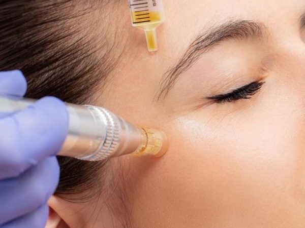 Is Microneedling with PRP the Secret to Younger-Looking Skin_