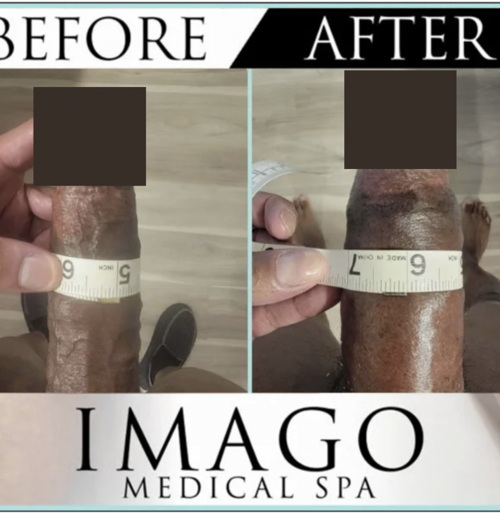Before and after non surgical permanent penis enlargement medical procedure by Imago Medical Spa
