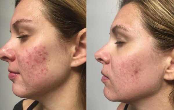 VI-Peel-Before-After-1-1-1024x673